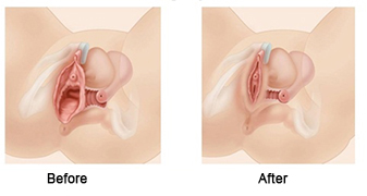 Vaginoplasty-Tunisia